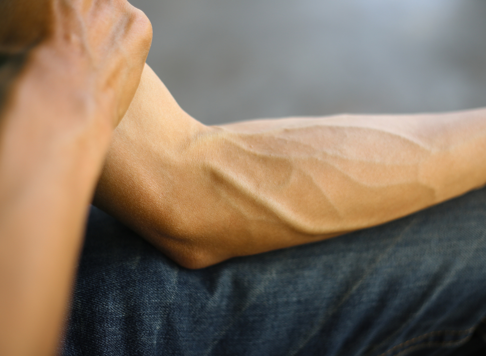 What Is Tommy John Surgery