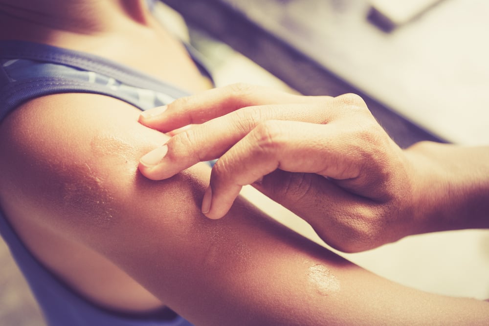 10 Tips for Insect Bite Treatment Facty Health