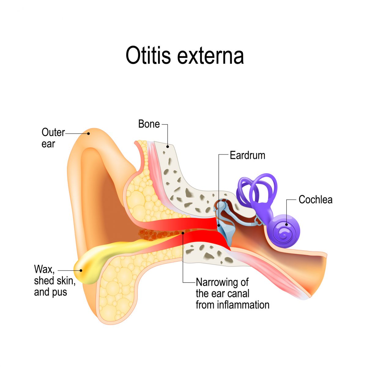 Frequently Asked Questions About Otitis Externa Facty Health