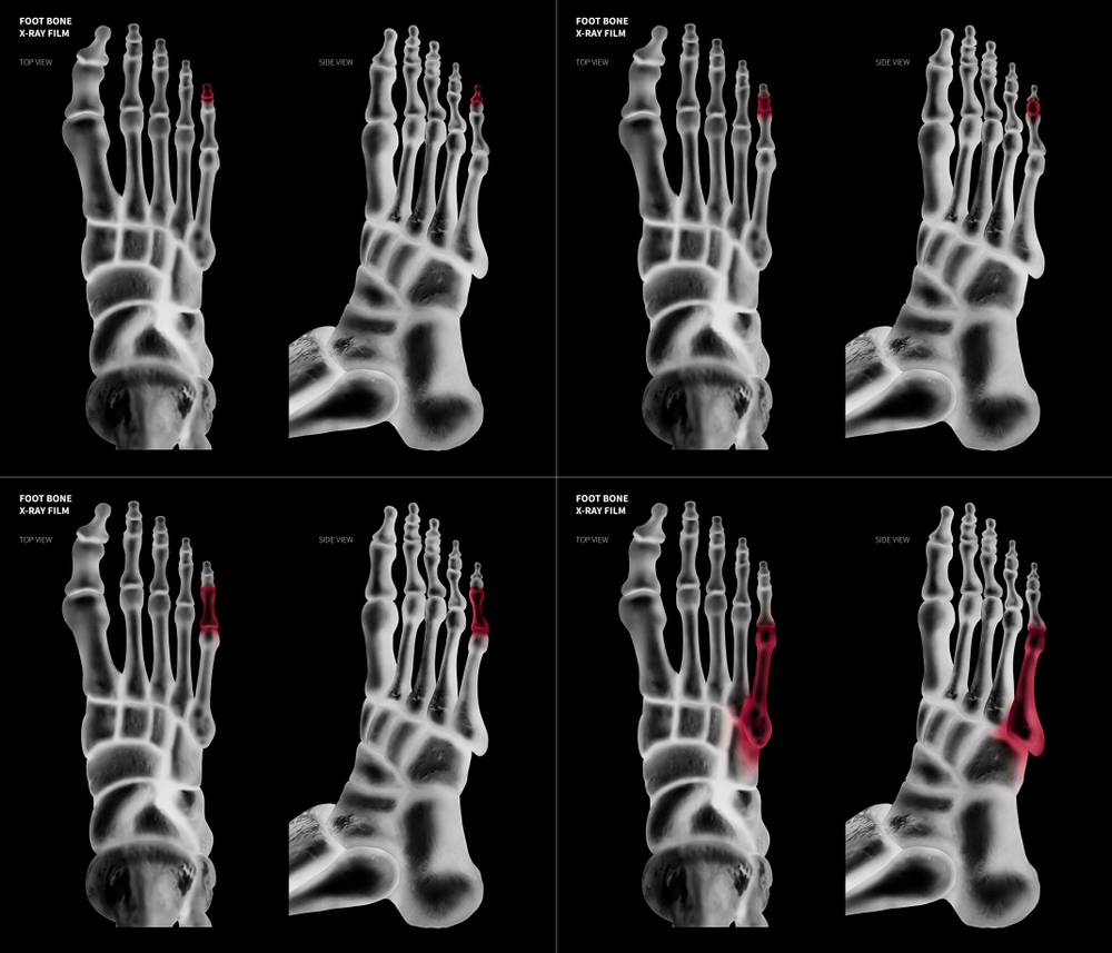 Things to Know About Broken Toes Facty Health