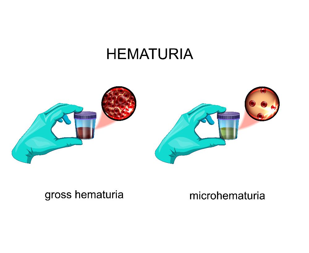 Frequently Asked Questions about Microscopic Hematuria Facty Health