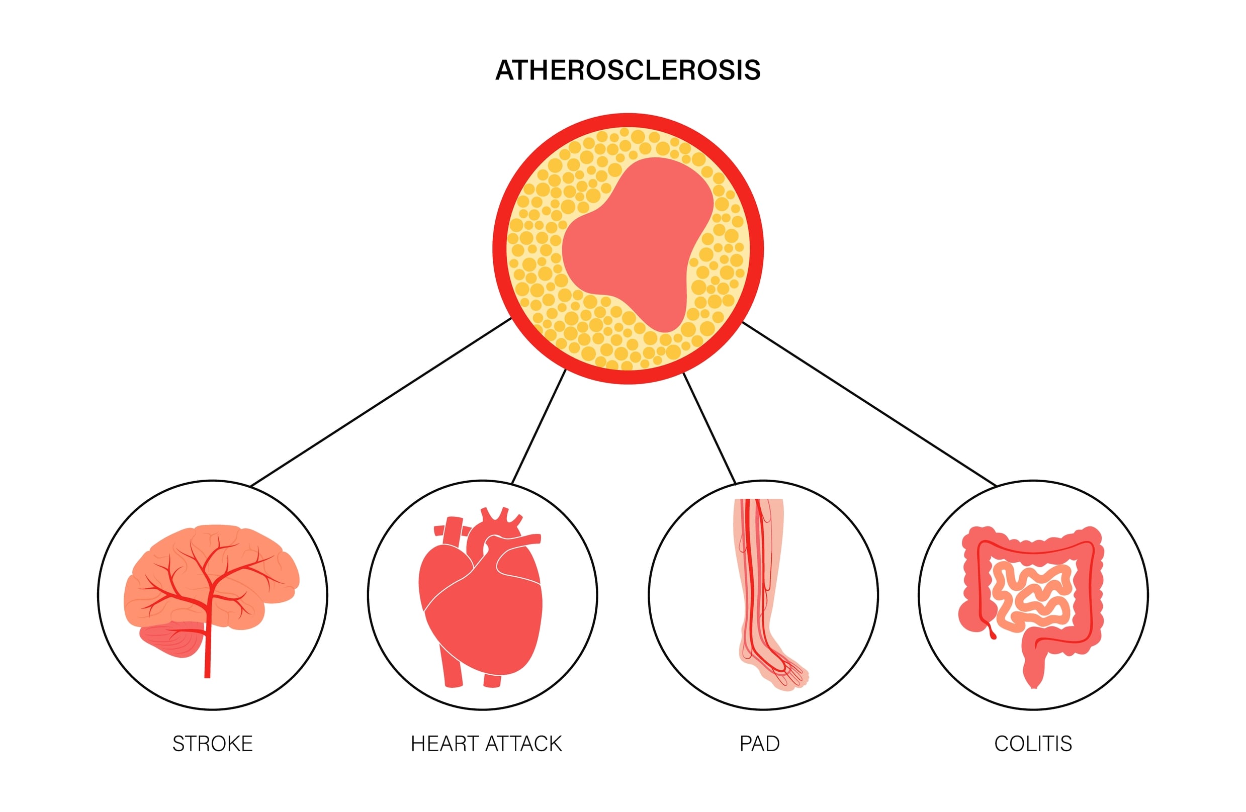 Myocardial and mesenteric ischemia, brain stroke and peripheral artery disease. 