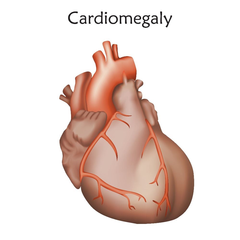 What is an Enlarged Heart? Facty Health