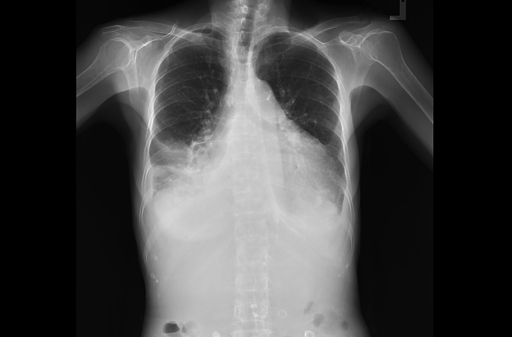 What is an Enlarged Heart? Facty Health