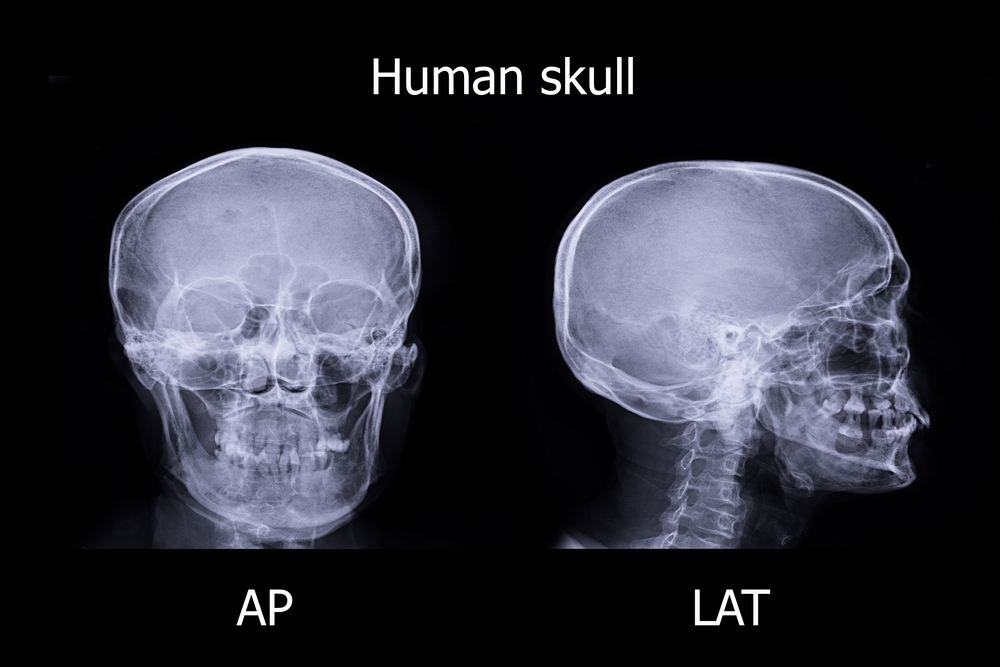 10 Facts About Apert Syndrome - Facty Health