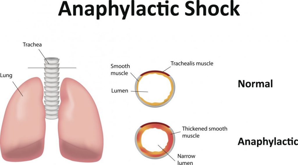 What Are the Symptoms and Treatments of Wasp Stings? Facty Health