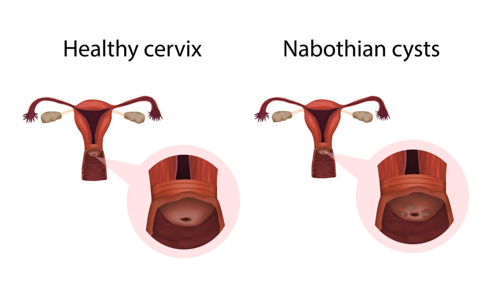 Nabothian cysts and healthy organ. Cervical disease. Medical anatomy illustration.