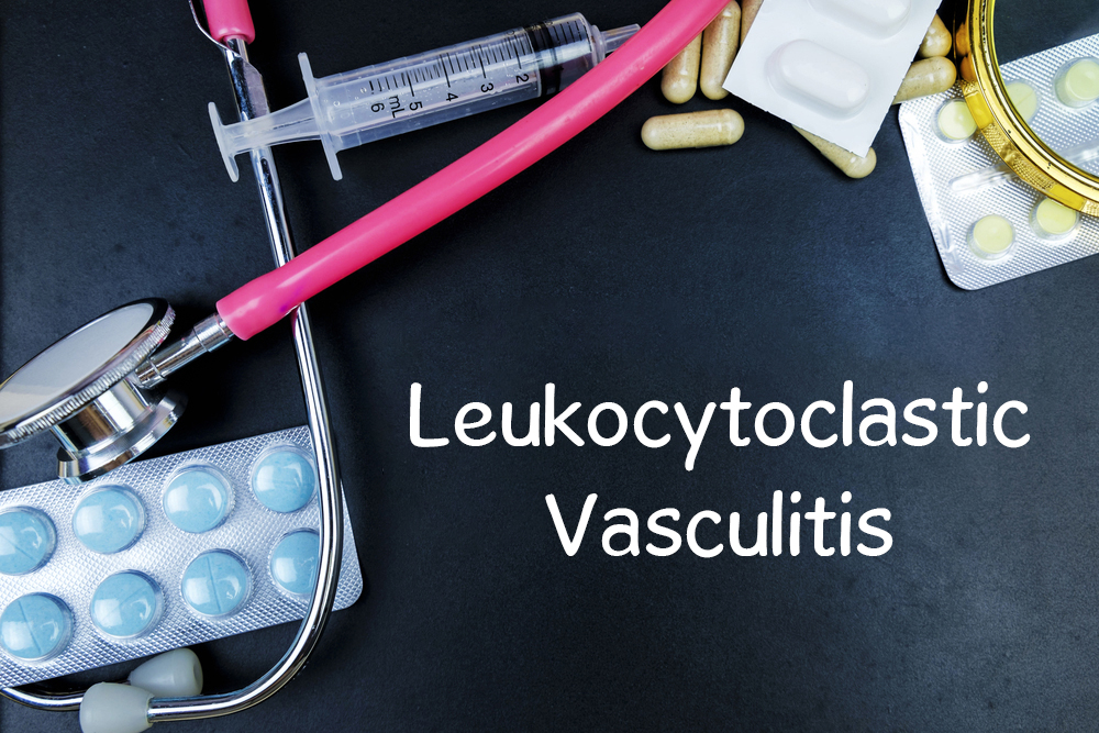 Symptoms and Risks of Leukocytoclastic Vasculitis - Facty Health