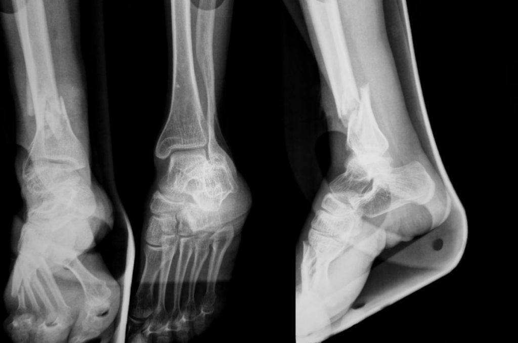What is Charcot Foot? Facty Health
