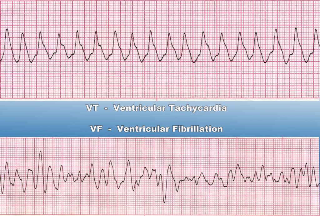 long-qt-syndrome-can-cause-arrhythmia-facty-health