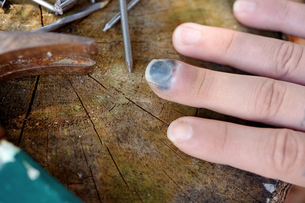 Blood Under the Nail Subungual Hematoma Facty Health