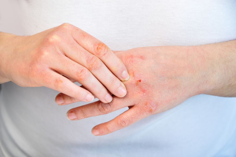 What Is Dermatomyositis? Facty Health