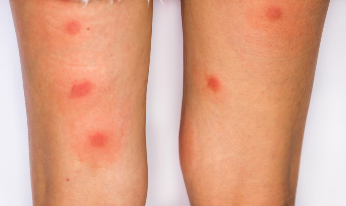 Skin Lesions That Look Like Insect Bites