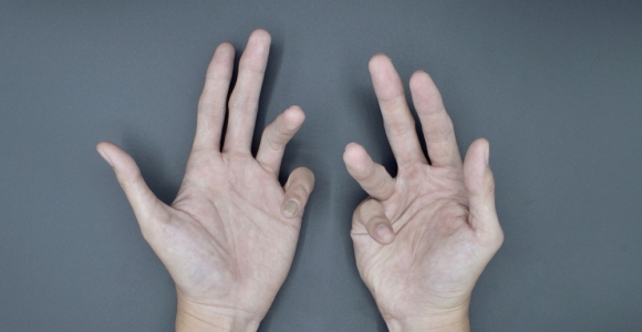 Contracture and Its Many Causes Facty Health