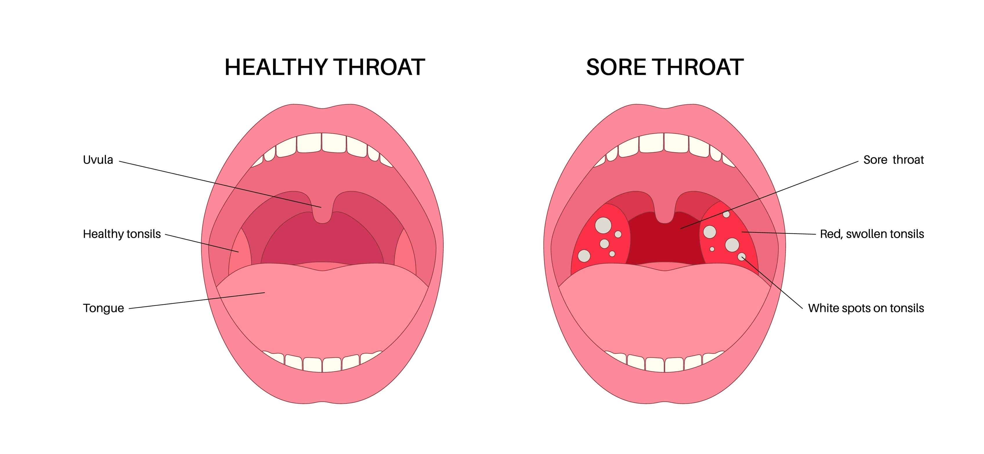 Sore throat or pharyngitis and healthy mouth